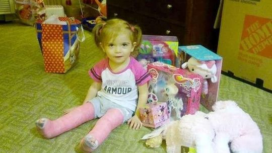 2-letnia Julka przeszła w USA zabieg wydłużania nóżek. "Najgorsze  już za nami"