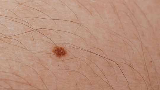 Dermatolog bezpłatnie zbada znamiona