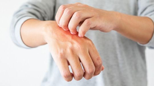 Dobre maści na atopowe zapalenie skóry