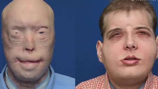 Dostał nową twarz i drugie życie. Strażak już po przeszczepie