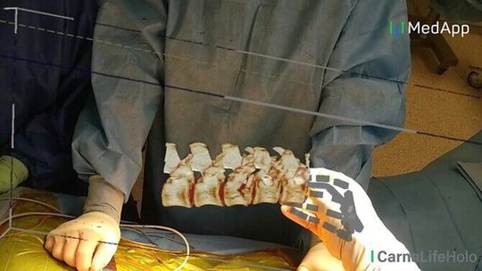 Hologramy i gogle. Tak lubelscy lekarze zoperowali kręgosłup