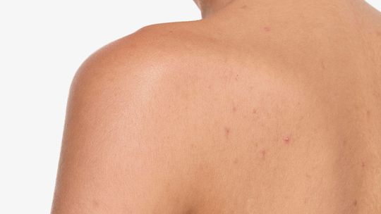 Jak połączyć pielęgnację przeciwtrądzikową z łagodzeniem podrażnień?