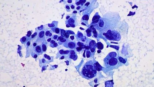 Jak powstaje nowotwór złośliwy?