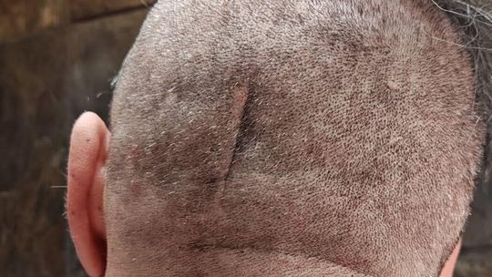 Jechał na rowerze bez kasku. Dziś tego żałuje