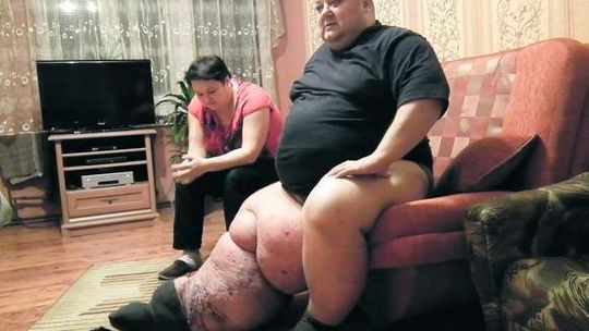 Jego noga ważyła ponad 80 kg. Mężczyzna wraca do zdrowia
