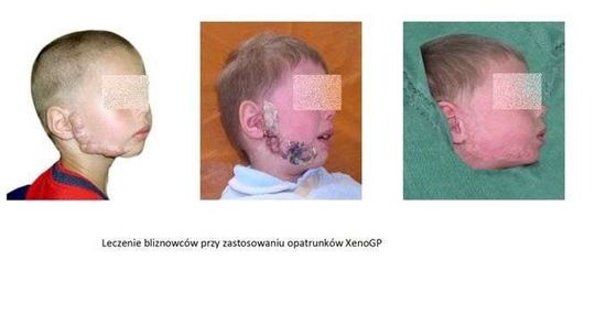 Lubelska firma stworzyła innowacyjny plaster. Rany goją się znacznie szybciej