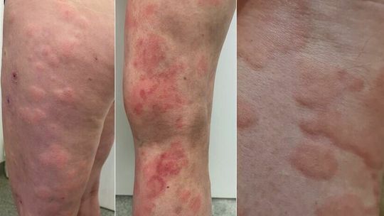 Lubelski szpital będzie bezpłatnie badać pod kątem pokrzywki