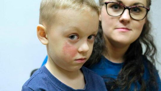 Lubelskie. Mały Mikołaj ma poparzoną twarz, a chciał tylko zdezynfekować ręce w przedszkolu