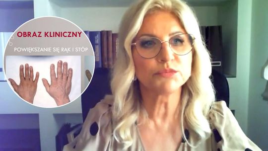 Objawy często są bagatelizowane. "Chorzy przyzwyczajają się do swoich zmienionych rysów twarzy"