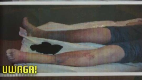 Pacjent pozostawiony sam sobie. Czekał na pomoc wiele godzin, zmarł po zabiegu