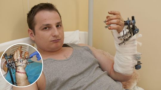 Przeszedł potworny wypadek, dłoń wisiała tylko na zmiażdżonych ścięgnach. Dziś mówi: Lekarze z Łęcznej uratowali mi rękę!