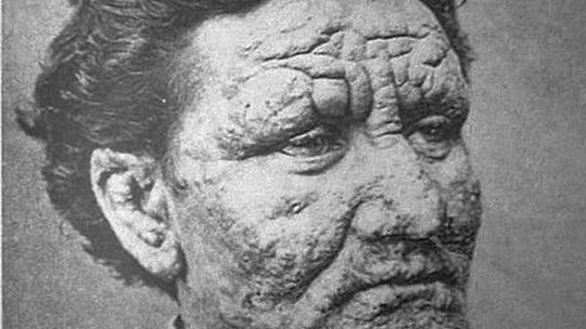 Światowy Dzień Trędowatych: Będzie zbiórka do puszek