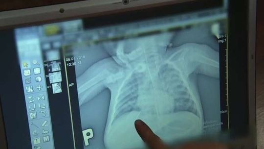 Szpital wypisał dziecko z igłą w płucach. Jego stan błyskawicznie się pogarszał