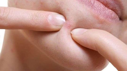 Trądzik – często ignorowane zagrożenie