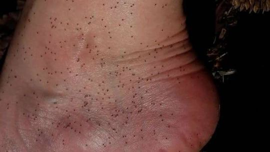 Weszła w gniazdo kleszczy i nawet nie poczuła, że coś przyczepiło jej się do nogi [zdjęcie]