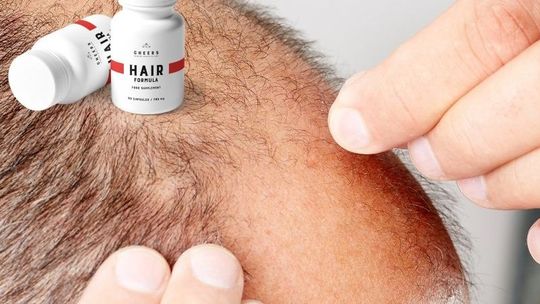 Wypadanie włosów u mężczyzn – genetyka czy niewłaściwy styl życia? Wypadanie włosów u mężczyzn – genetyka czy niewłaściwy styl życia?