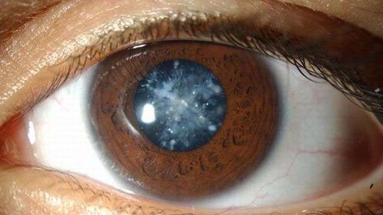 Zaćma cukrzycowa – jak ją rozpoznać?