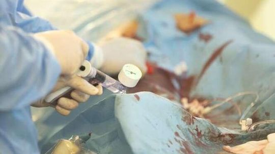 Zmiany w finansowaniu zabiegów kardiologicznych. "Cofniemy się o kilka lat"
