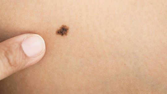 Znamiona pod lupą – podejrzany pieprzyk lepiej sprawdzić