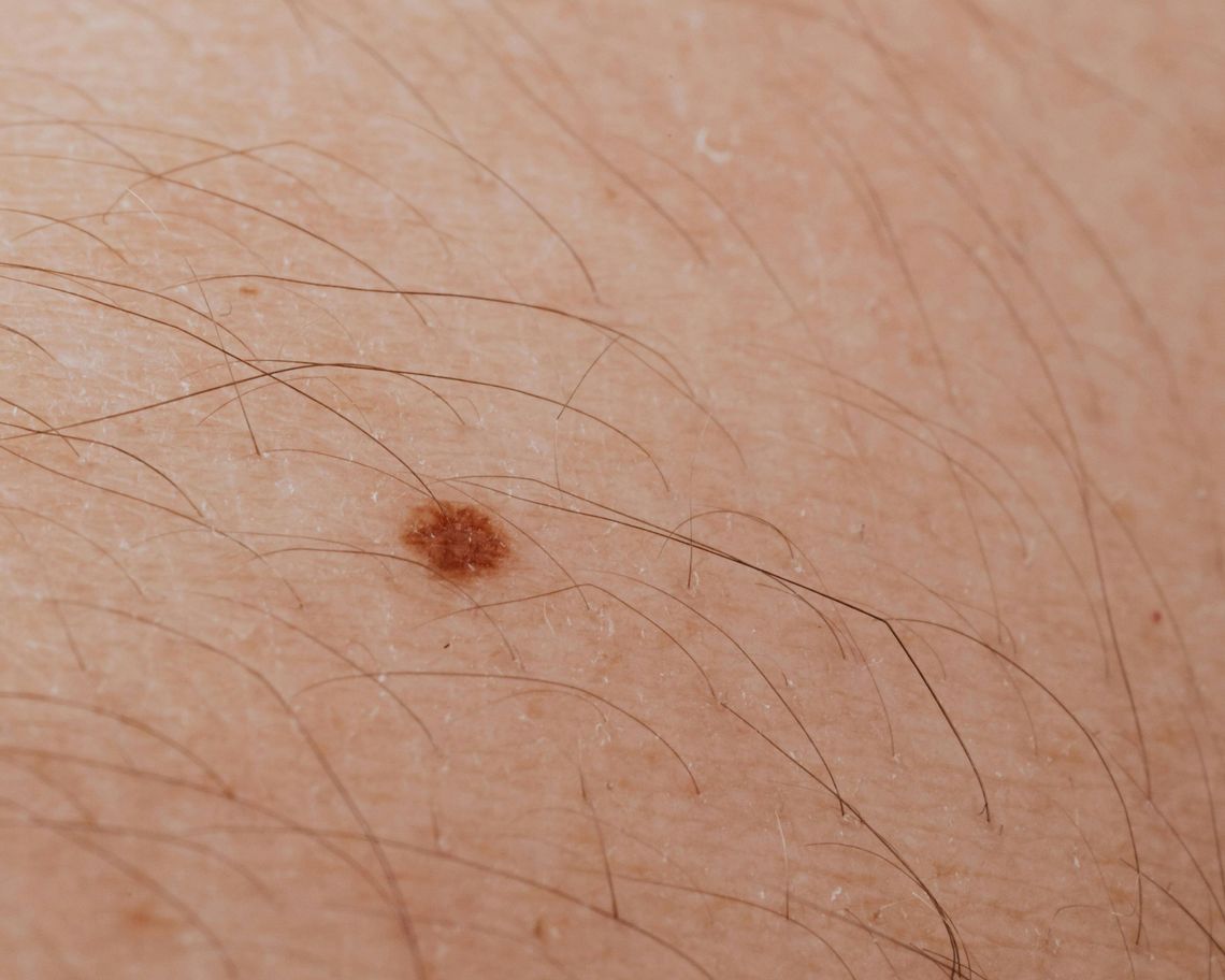Dermatolog bezpłatnie zbada znamiona