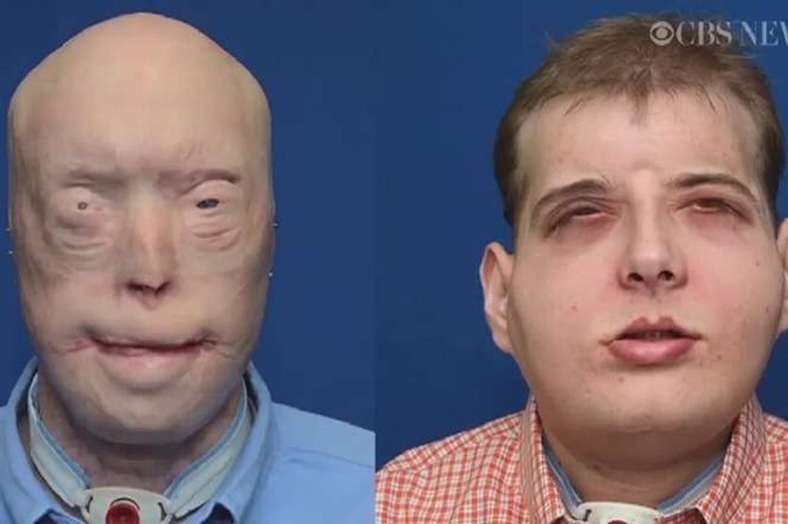 Dostał nową twarz i drugie życie. Strażak już po przeszczepie