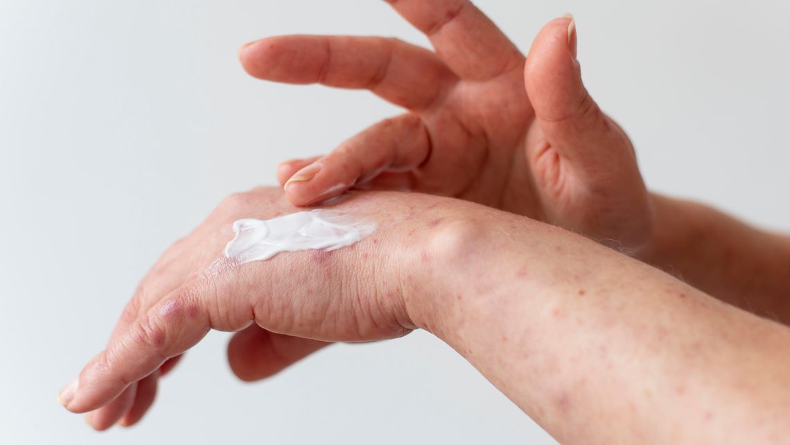 Egzema dłoni: przewodnik po objawach, przyczynach i leczeniu