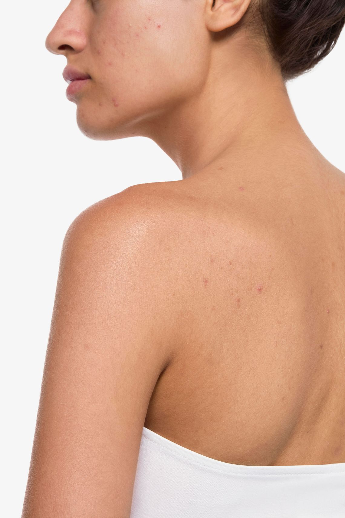 Jak połączyć pielęgnację przeciwtrądzikową z łagodzeniem podrażnień?