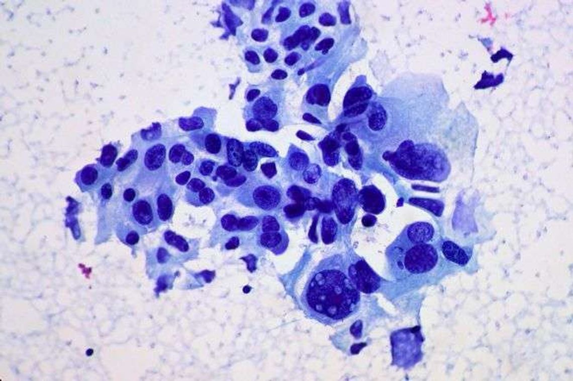 Jak powstaje nowotwór złośliwy?