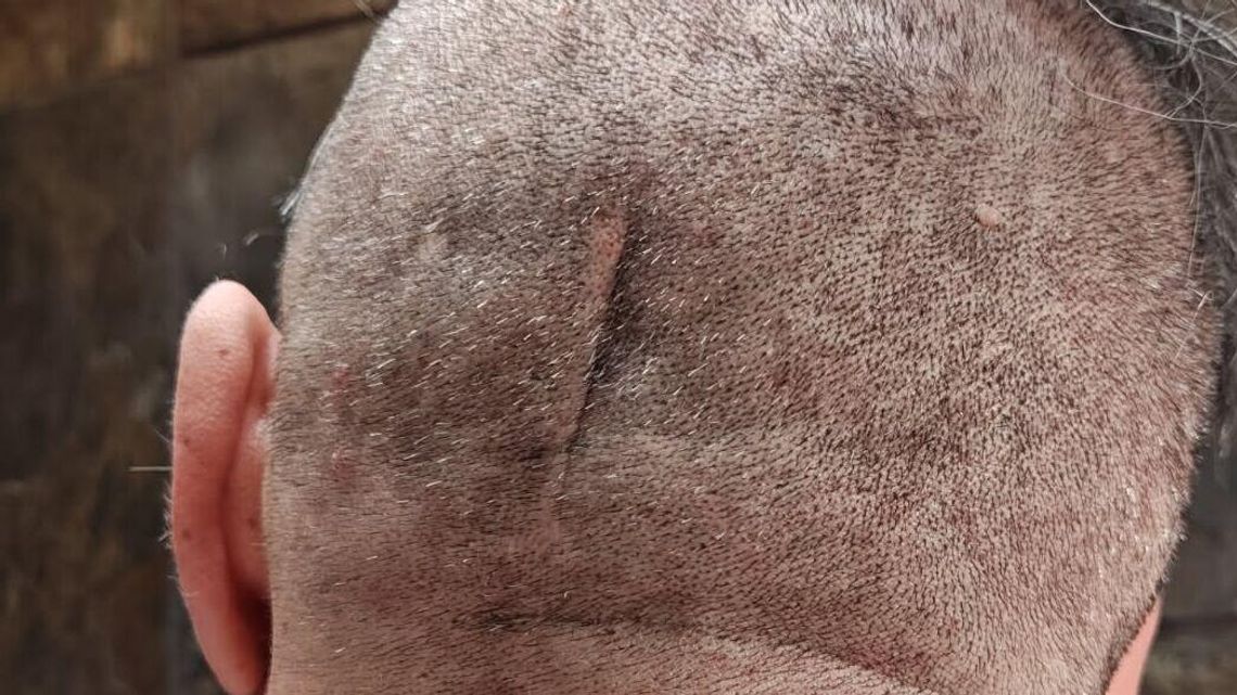 Jechał na rowerze bez kasku. Dziś tego żałuje Jechał na rowerze bez kasku. Dziś tego żałuje