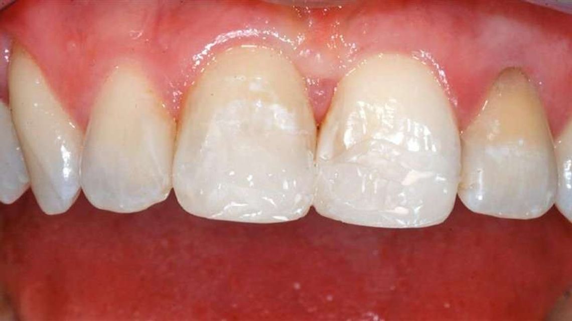 Licówki porcelanowe - bezbolesny sposób na piękny uśmiech.