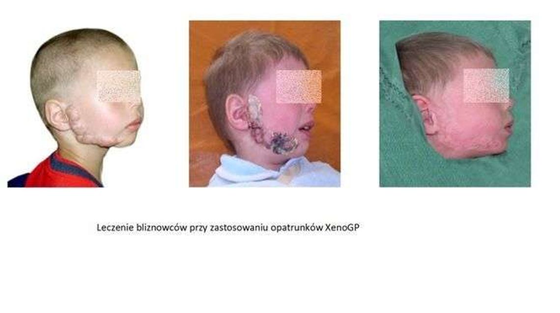 Lubelska firma stworzyła innowacyjny plaster. Rany goją się znacznie szybciej