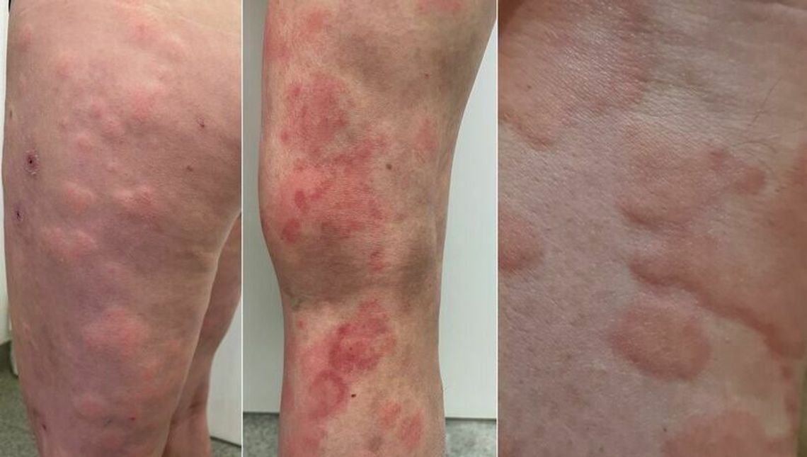 Lubelski szpital będzie bezpłatnie badać pod kątem pokrzywki Lubelski szpital będzie bezpłatnie badać pod kątem pokrzywki