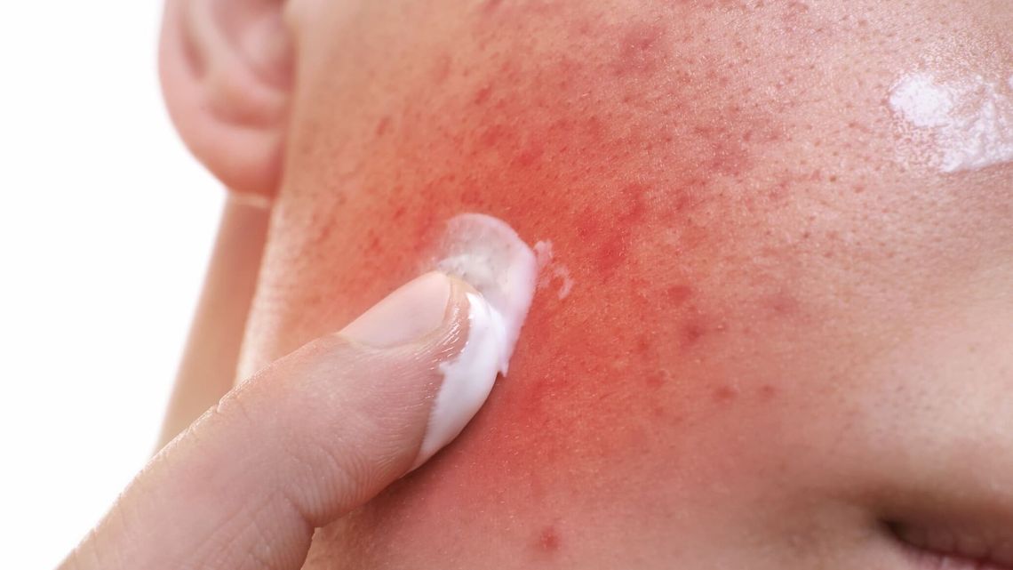 Masz cerę naczynkową? Tych kosmetyków lepiej nigdy nie używaj!