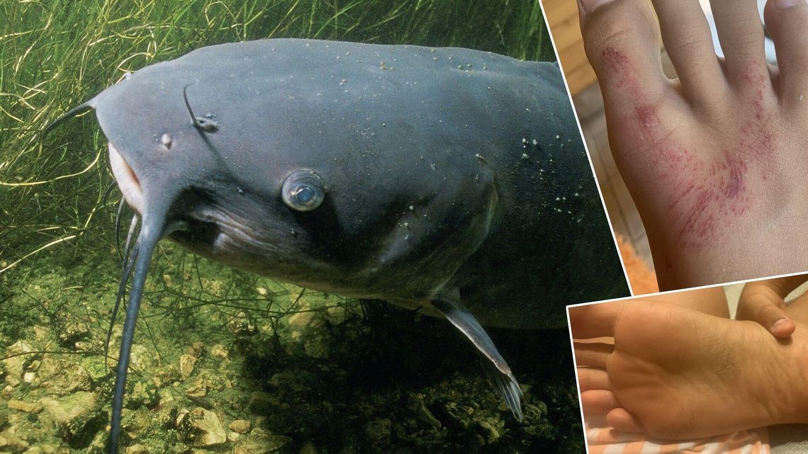 Na stopie chłopca został tylko ślad po ugryzieniu. Zaatakował sum-gigant z jeziora Białego?