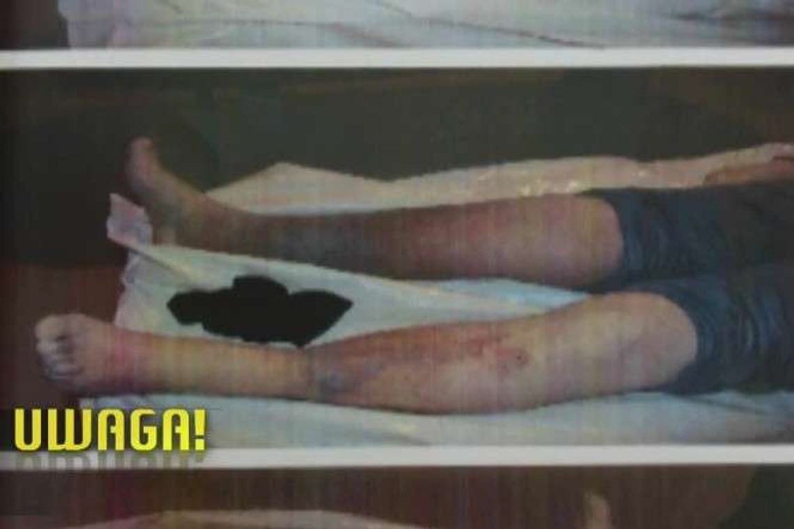 Pacjent pozostawiony sam sobie. Czekał na pomoc wiele godzin, zmarł po zabiegu Pacjent pozostawiony sam sobie. Czekał na pomoc wiele godzin, zmarł po zabiegu