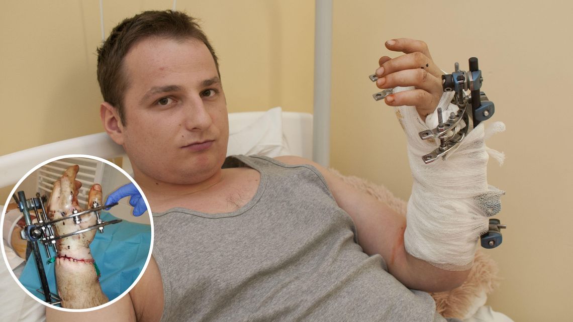 Przeszedł potworny wypadek, dłoń wisiała tylko na zmiażdżonych ścięgnach. Dziś mówi: Lekarze z Łęcznej uratowali mi rękę! Przeszedł potworny wypadek, dłoń wisiała tylko na zmiażdżonych ścięgnach. Dziś mówi: Lekarze z Łęcznej uratowali mi rękę!