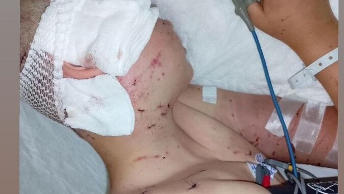 Psy pogryzły dziecko. Potrzeba pieniędzy na leczenie Piotrusia Psy pogryzły dziecko. Potrzeba pieniędzy na leczenie Piotrusia