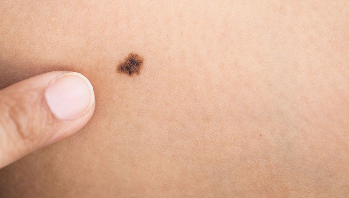 Statystyki alarmują! Na tego raka chorują coraz młodsi. "Wielu ignoruje objawy"