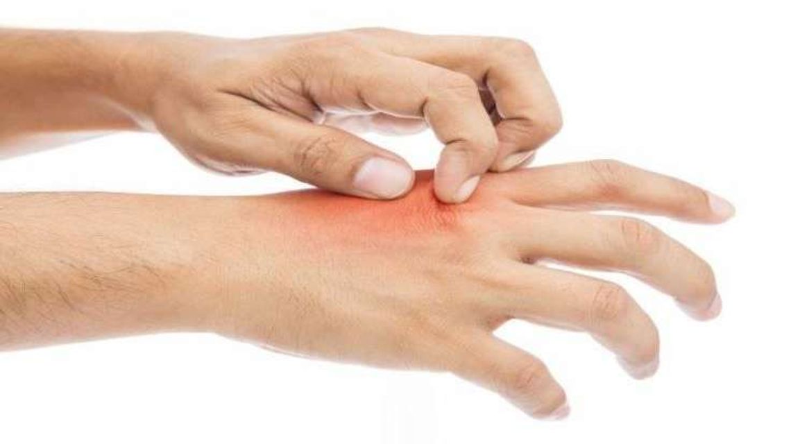 Świerzb, co musisz o nim wiedzieć?