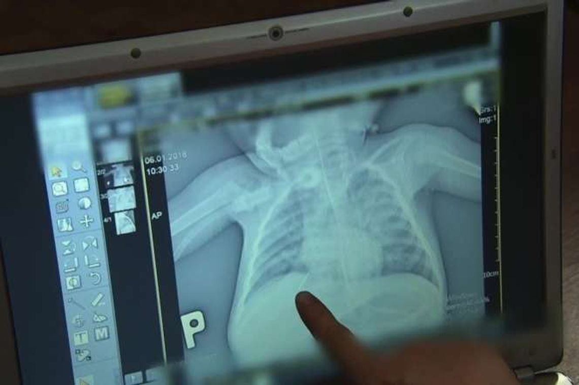 Szpital wypisał dziecko z igłą w płucach. Jego stan błyskawicznie się pogarszał