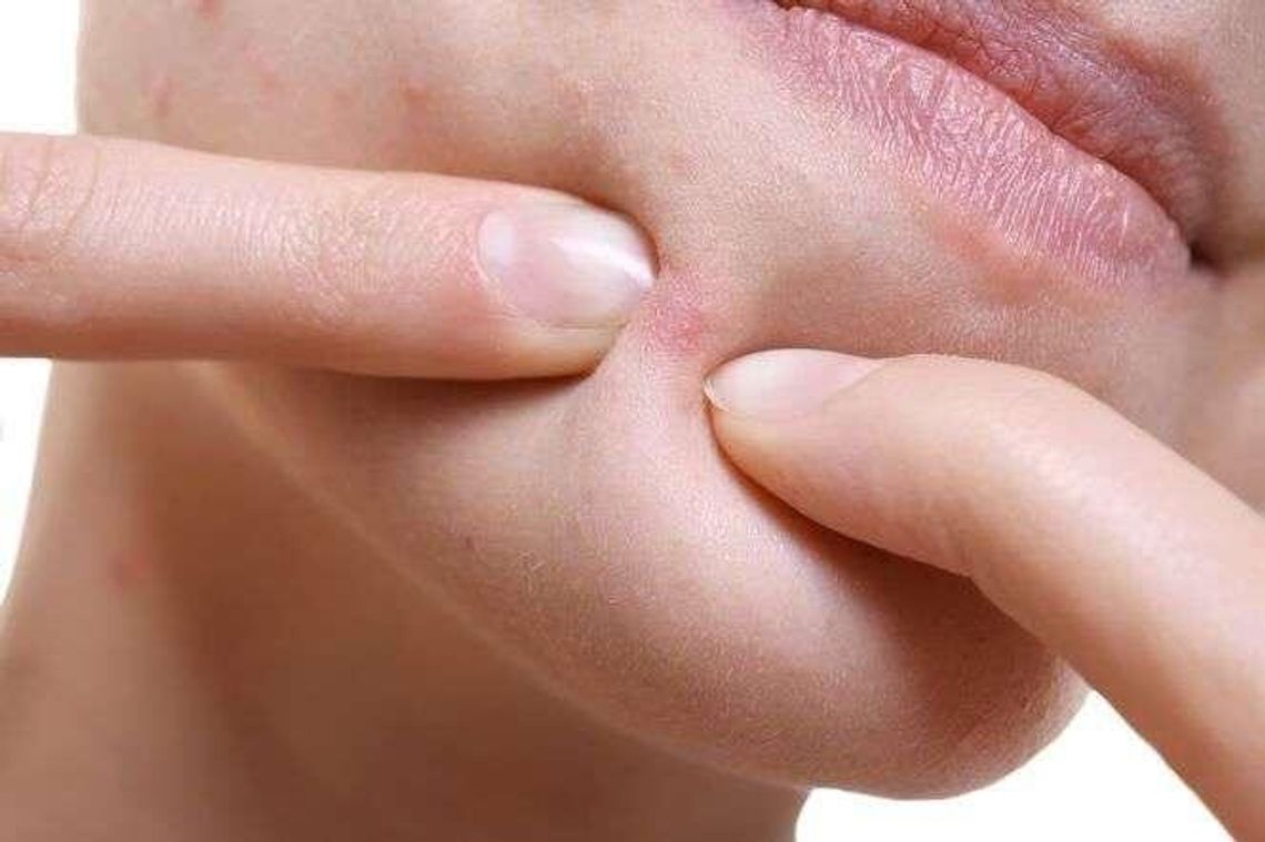 Trądzik – często ignorowane zagrożenie