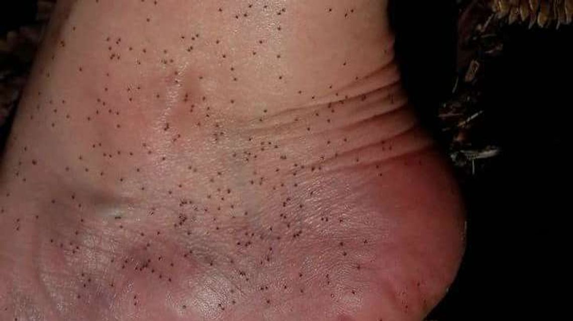 Weszła w gniazdo kleszczy i nawet nie poczuła, że coś przyczepiło jej się do nogi [zdjęcie]