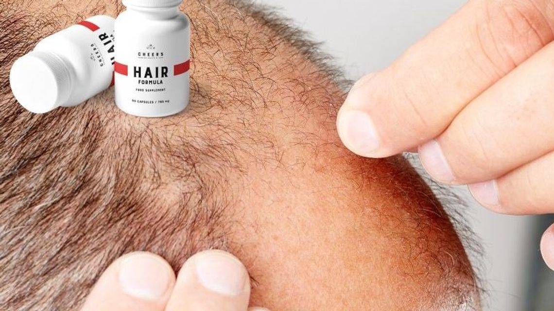 Wypadanie włosów u mężczyzn – genetyka czy niewłaściwy styl życia?