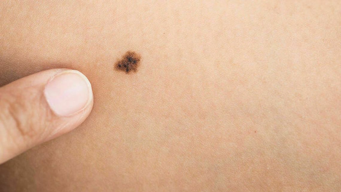 Znamiona pod lupą – podejrzany pieprzyk lepiej sprawdzić