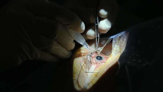 Operacja zaćmy w klinice okulistyki UM