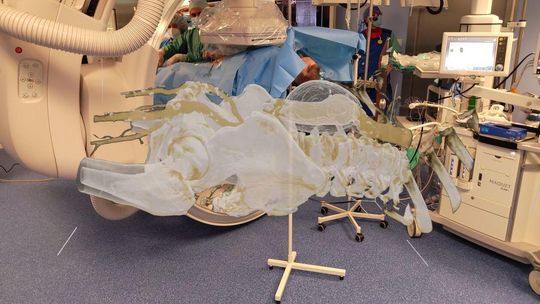 Nowatorska operacja w SPSK nr 1 w Lublinie Nowatorska operacja w SPSK nr 1 w Lublinie