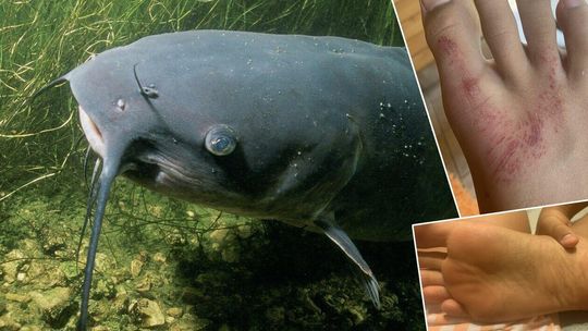 Obrażenia na nodze 12-latka