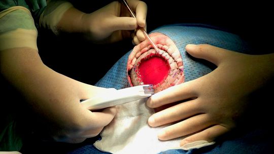 Chirurdzy rekonstruowali ubytek po zmianie nowotworowej