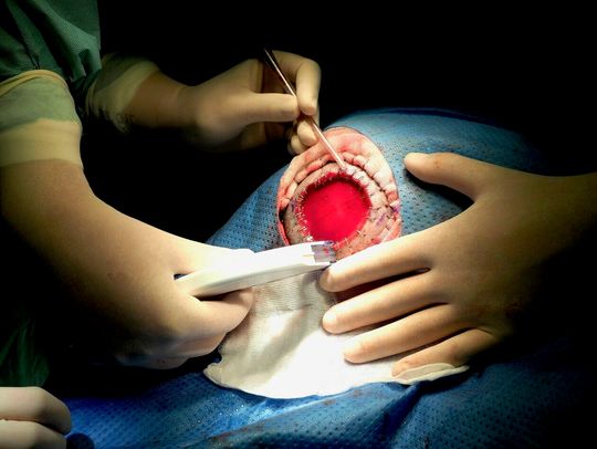 Chirurdzy rekonstruowali ubytek po zmianie nowotworowej