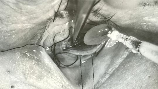 Operacja chirurgiczna oka dawnymi narzędziami